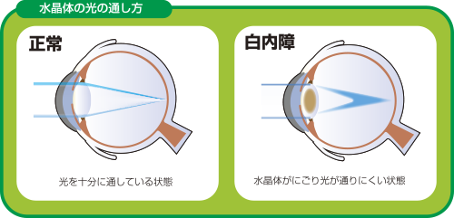 白内障の原因